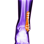Ankle-fracture-1080