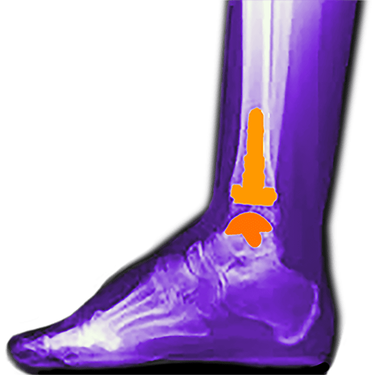 Arthroplasty Nisantasi FootPlus Clinic Specialized in Foot and