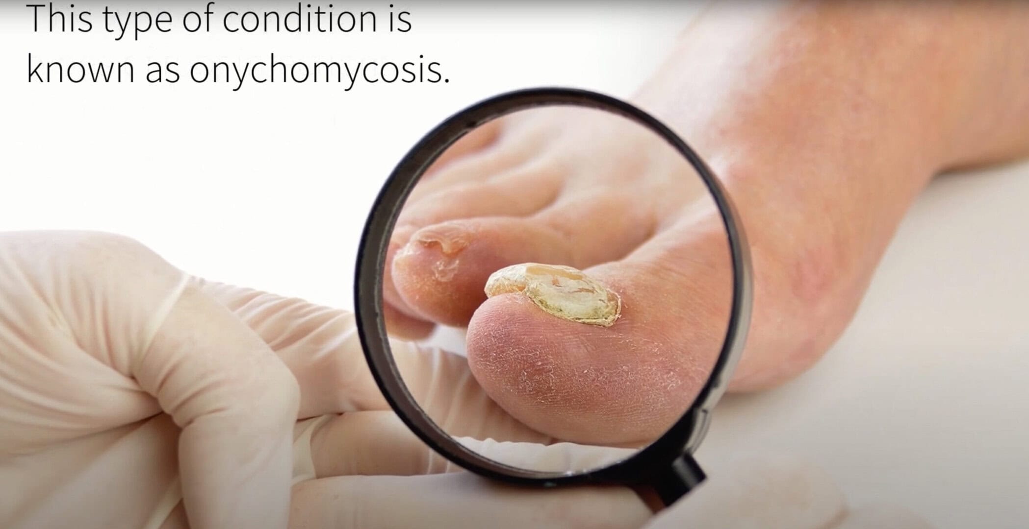 Remy_Onychomycosis_Video-BG