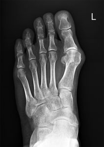 Nişantaşı FootPlus Kliniği'nde ayak sağlığı değerlendirmesi için kemik yapısını gösteren sol ayak parmaklarının yüksek çözünürlüklü röntgen görüntüsü.